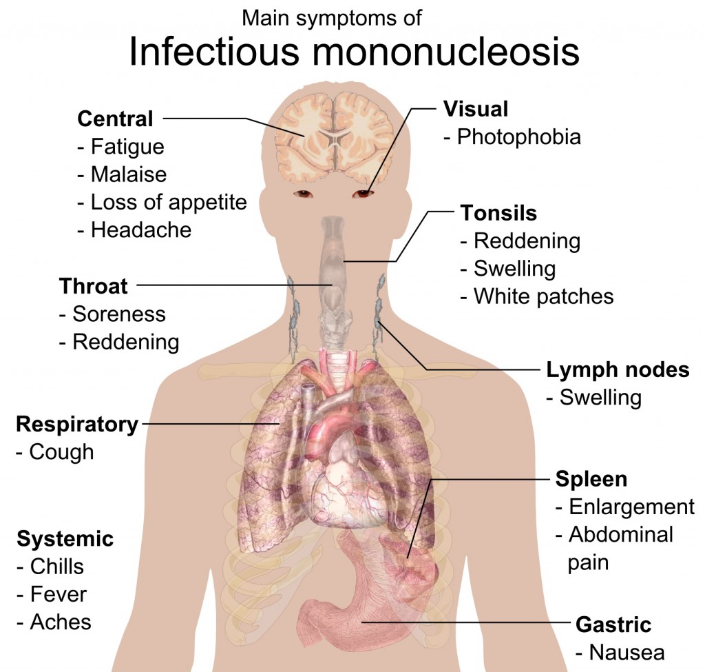 Mono symptoms