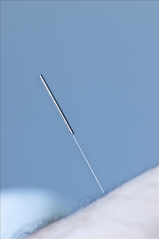 Closeup of acupuncture needle