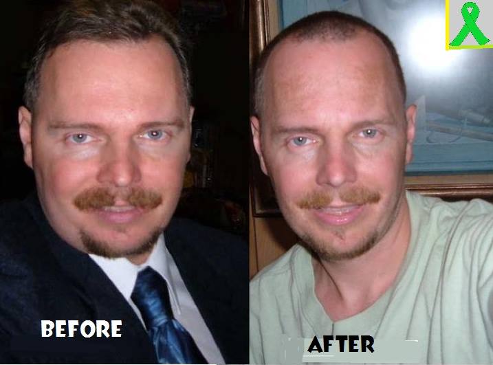 Michael Anderson, who had Lyme Disease, before and after picture