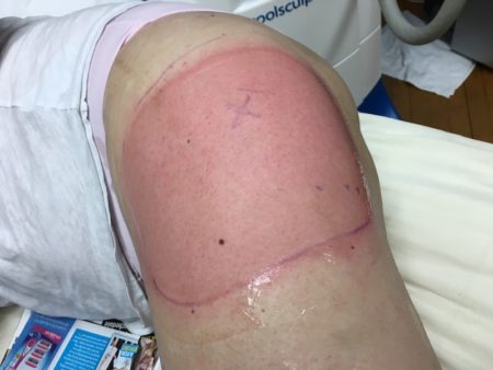 Red skin after CoolSculpting