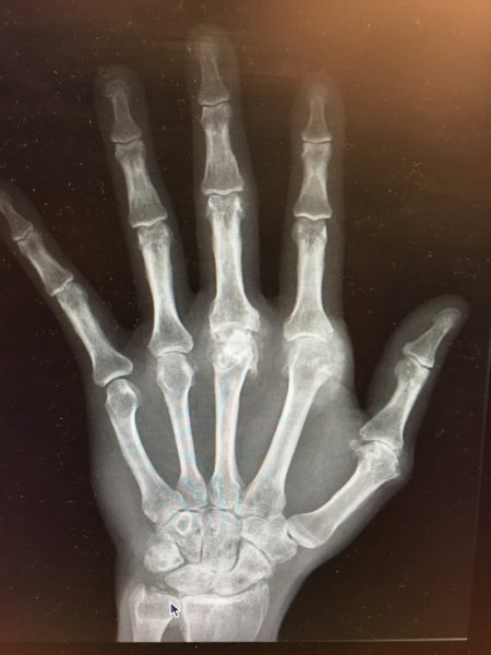 X-ray that shows tophi in Patrick's hands