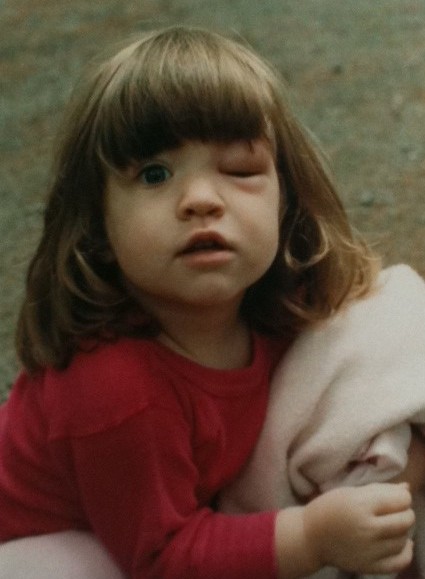 Katharine with black fly bite