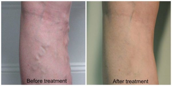 Before/after varicose veins