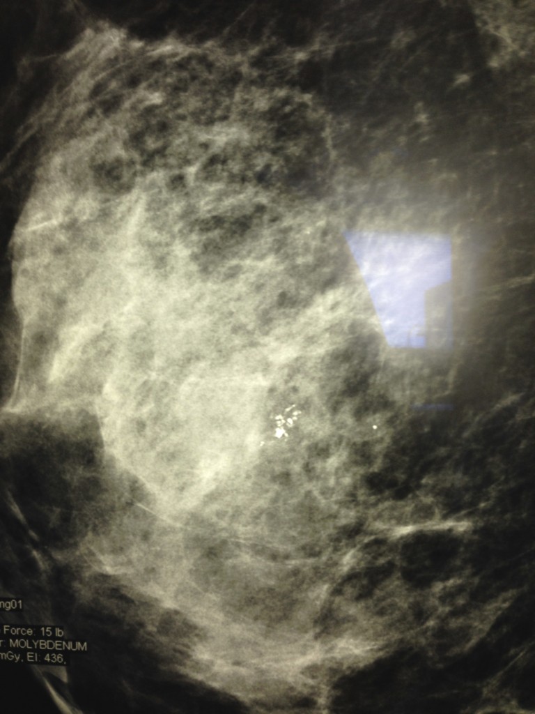 Microcalcifications on my mammogram