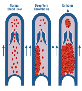 World Thrombosis Day | Catching Health with Diane Atwood