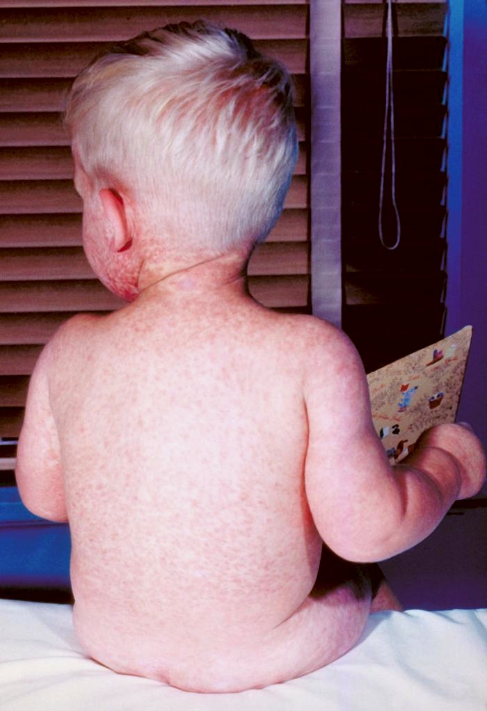 Boy with measles