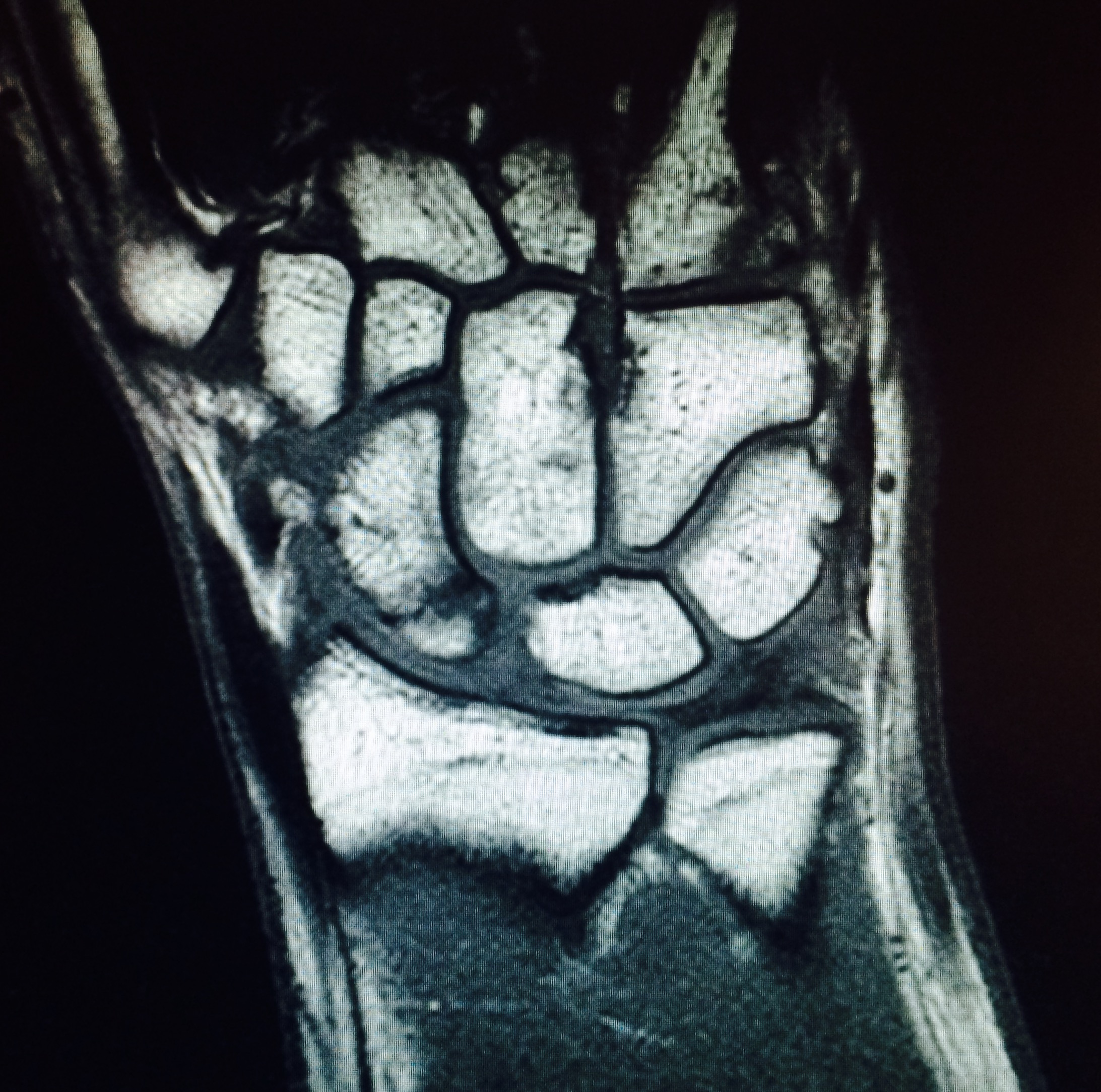 MRI wrist