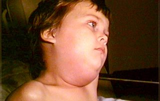 Boy with mumps