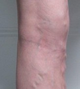 varicose veins