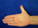 Active radial thumb exercise