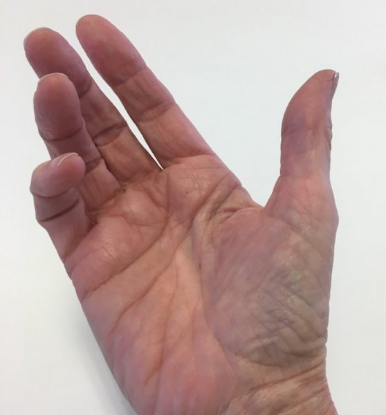 Oh, my aching thumb Catching Health with Diane Atwood