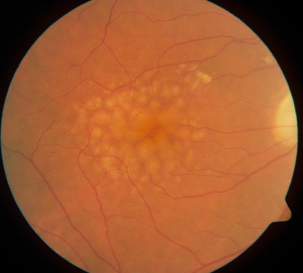 Drusen in retina/Macular degeneration