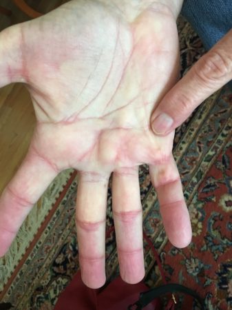 Dupuytren's Contracture cord