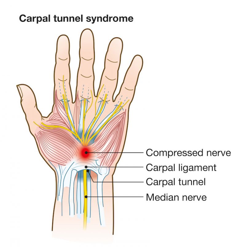 what-causes-carpal-tunnel-syndrome-catching-health-with-diane-atwood