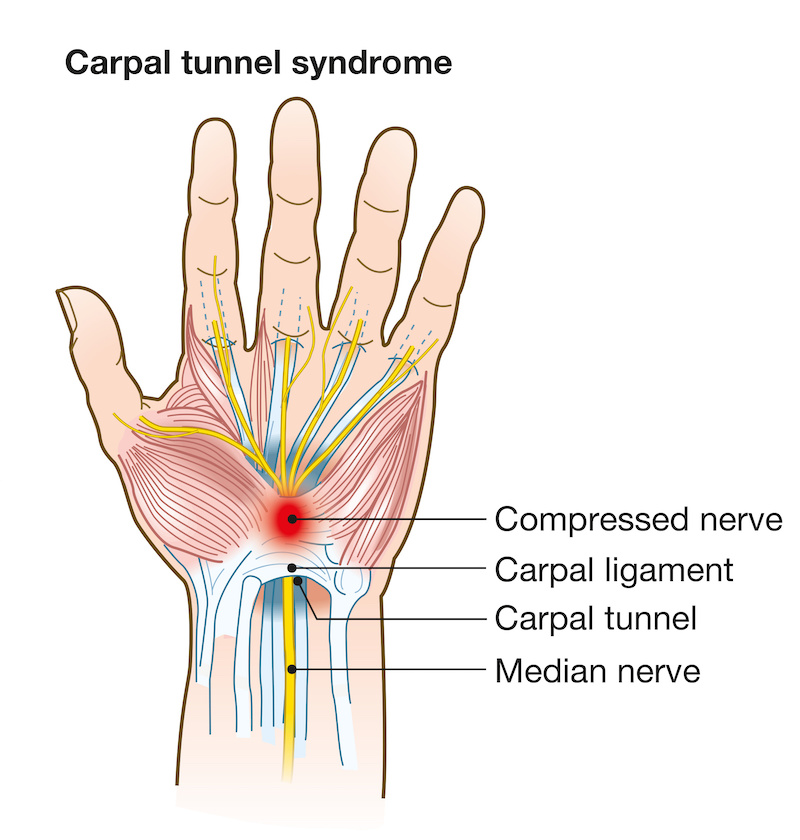 What causes carpal tunnel syndrome? Catching Health with Diane Atwood