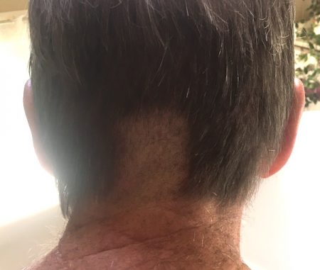 The shaved strip on my husband's head