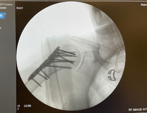 x-ray of plate and pins in broken shoulder