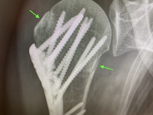 Shoulder x-ray