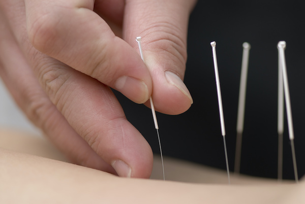 Inserting acupuncture needles