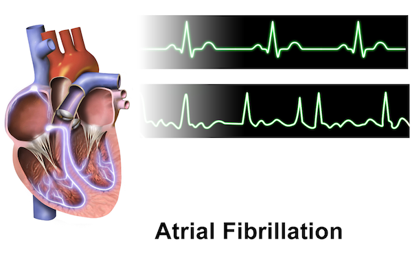 Atrial fibrillation