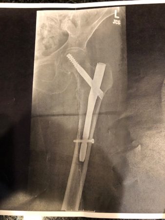Judith Wolf Mandell broken femur/accident